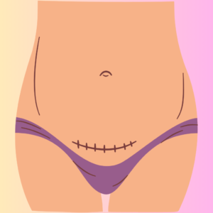 Recuperação da cesárea: como cuidar do corpo e da mente